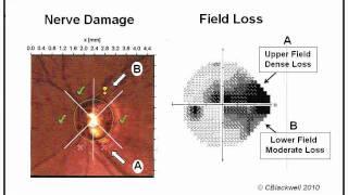 Glaucoma 1 Diagnosis