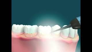 Dental Video for Prophylaxis - The Tooth