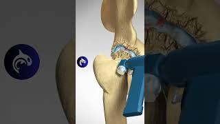 Total Hip Replacement (Arthroplasty) - 3D Animation