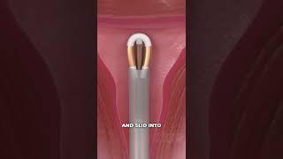 Copper IUD Birth Control (3D Animation)