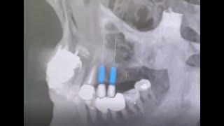 Digital X-Rays at Dental Wellness of Charlotte