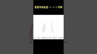 항문주위농양이 치루가 되는 과정_예스항외과