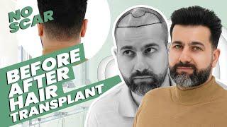 Before and  After Hair Transplant