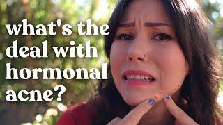 HORMONAL ACNE | Why It Happens & What To Do About It!