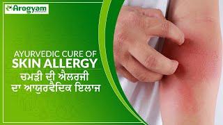 Ayurvedic Treatment of Skin Allergy || Arogyam Ayurveda || +91 9216001410