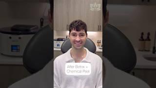 Before + After: Botox with Chemical Peel