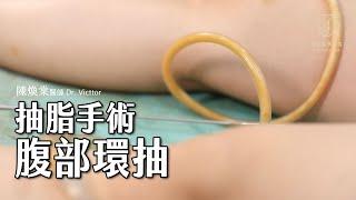 【抽脂手術】抽脂手術腹部環抽｜#陳煥棠教授 Dr. Samuel｜#金貞醫學美容