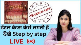 19 Dental Cap live procedure by Dr Vishakha Jain | Seraphic Dental Indore | Best Dentist in indore