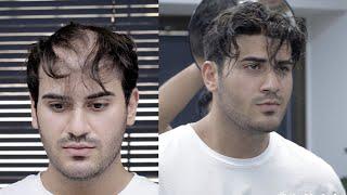 PROTEZ SAÇ UYGULAMASI - Kaliteyi Hisset! - Hair Replacement