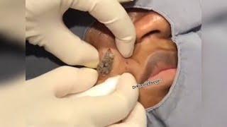 Popping huge blackheads and Pimple Popping - Best Pimple Popping Videos 62