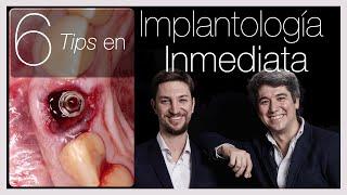 ️Implante Dental Post extracción o ️ INMEDIATOS: 6 tips fundamentales - [Aprende Implantología]