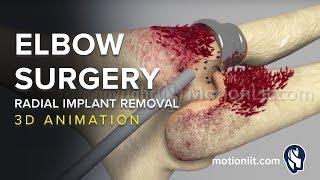 Elbow Surgery Radial Implant Removal - 3D Medical Animation