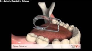 Space Regainer - Ottawa Dentists