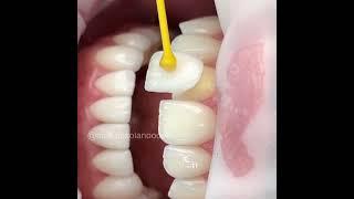 Veneers #dentist #dentalcare  #veneers #dentalsmiledesigning #shorts