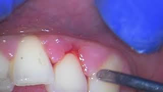 Ultrasonic teeth cleaning (watch why your gums bleed)