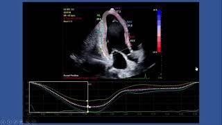 Strain Echocardiography by speckle tracking and tissue Doppler -Part I:technique