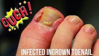 Infected Ingrown Removal!