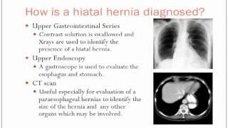 Hiatal Hernias