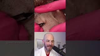 Derm reacts to ingrown hair pimple pop combo! #dermreacts #doctorreacts #pimplepop #ingrownhair