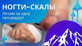 НОГТИ-СКАЛЫ. ГРИБОК НОГТЕЙ И ОТКРЫТАЯ ОБУВЬ. ЛЕЧИМ ЗА ОДНУ ПРОЦЕДУРУ.