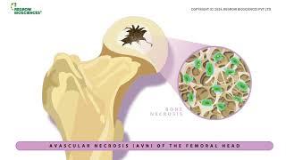 OSSGROW for Avascular Necrosis of Hip Joint