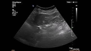 Аневризма правой долевой ветви воротной вены/Aneurysm of the right lobar branch of the portal vein