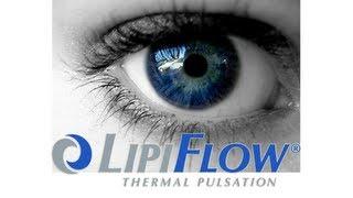 Lipiflow  Thermal Pulsation - Dry Eye Treatment