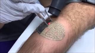 Laser Tattoo Removal at Skin Deep in Northern VA