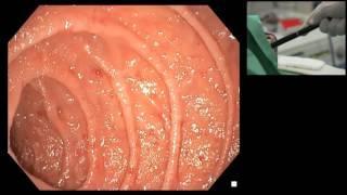 Live demonstration: IDA, Osler-Weber-Rendu disease: motorized spiral enteroscopy, APC