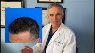 Hair Transplant Case Study - Dr. Scott Boden - Connecticut