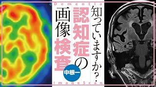 知っていますか？　認知症の画像検査　　その役割・種類・典型所見などをわかりやすく解説！