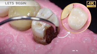 AMAZING 4K Dental Restoration #ASMR