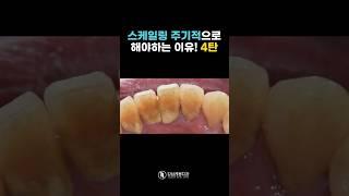 스케일링 주기적으로 해야하는 이유 4탄  #강남레옹치과 #스케일링 #잇몸치료