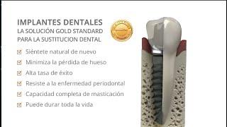 Implantes dentales BioHorizons El gold standard para el reemplazo de dientes