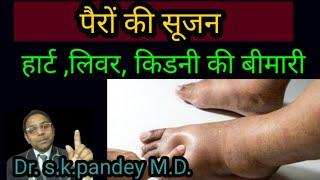 पैर का सूज जाना Dr. s.k.pandey M.D.