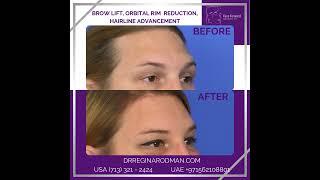 Brow Lift + Orbital Rim Reduction + Hairline Advancement