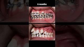 How to braces fix extremely crooked teeth #braces #orthodontist #bracesoff