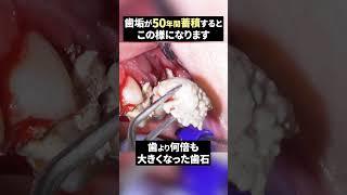 【歯石成敗】️歯磨きをしないとこうなります#歯石除去 #歯医者 #ザホワイトデンタルクリニック
