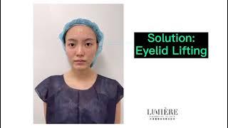 Minimally invasive Eyelid Lifting procedure 微创提眼皮