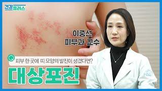 면역력이 저하되기 쉬운 겨울철, 피부에 물집이 통증과 함께 나타났다면 대상포진을 의심해보세요! 건강플러스 831화 | 25년 1월 11일