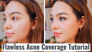 Flawless Acne Coverage Tutorial