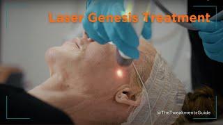 Laser Genesis Treatment for Improved Skin Health