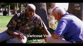 Varicose Vein in Men