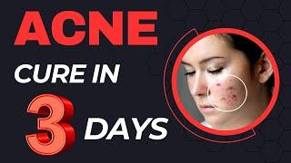 ACNE Problem solution | 3 din mein acne thik karen #acne #acnemarks #acnecream