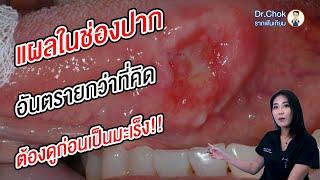 แผลแบบไหน ที่ทำให้เสี่ยง เป็นมะเร็งในช่องปาก ?!! | คลายปัญหาฟันกับทีมหมอโชค