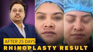 Rhinoplasty Results After 25 days || Nose job || Kolkata || Dr. Jayanta Bain plastic surgeon