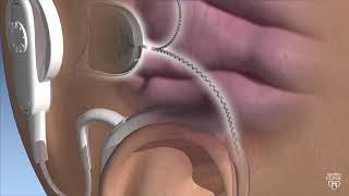 Mayo Clinic Minute: New technology for cochlear implants