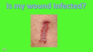 Infection : Is this wound infected