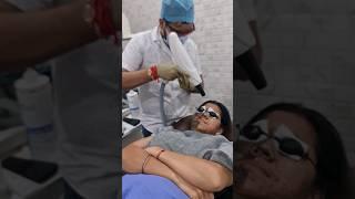 LASER CARBON PEEL #trending #shorts #short #viral #beauty #shortsfeed #health #skincare