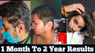 Minoxidil Hair Regrowth Results | Minoxidil 1 Month to 2 Years Complete Results